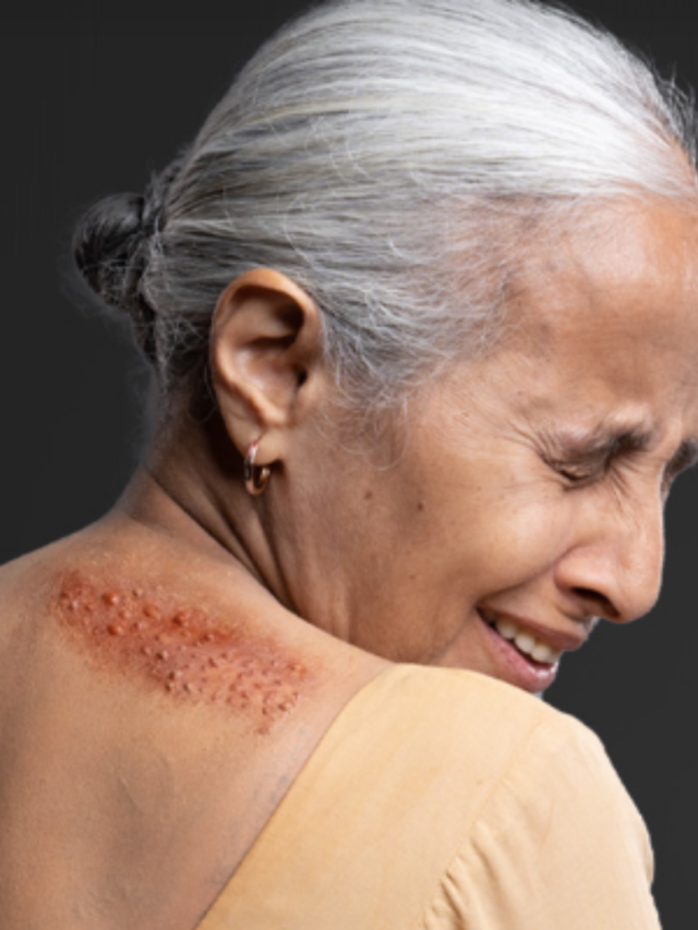 Herpes Shingles